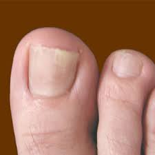szóda láb köröm gomba nail fungus körömbetegség